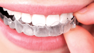 Is Invisalign Faster Than Braces?, Andrew Turchin