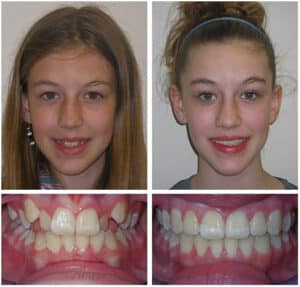 Allison Before and After at Orthodontic Specialist PC in in Brooklyn Staten Island NY and Metuchen NJ
