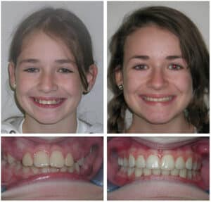 Boulay Before After Photos at Orthodontic Specialist PC inin Brooklyn Staten Island NY and Metuchen NJ