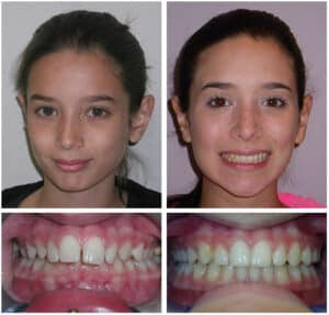 Castagliola Before After at Orthodontic Specialist PC in Brooklyn Staten Island NY and Metuchen NJ