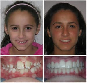 Cortes Before After Photos at Orthodontic Specialist PC in Brooklyn Staten Island NY and Metuchen NJ