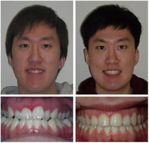 Daniel at Before After Orthodontic Specialist PC in Brooklyn Staten Island NY and Metuchen NJ