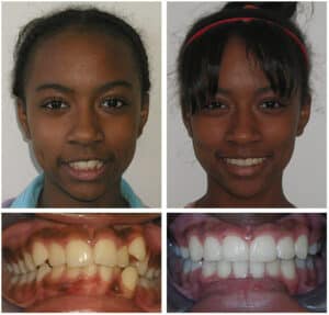 Griffin Before and After Orthodontic Specialist PC in Brooklyn Staten Island NY and Metuchen NJ