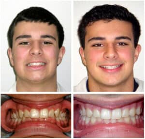Gullo Before After at Orthodontic Specialist PC in Brooklyn Staten Island NY and Metuchen NJ