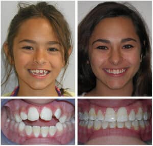 Hal Before After Orthodontic Specialist PC in Brooklyn Staten Island NY and Metuchen NJ