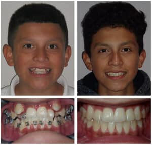 Jo Before After at Orthodontic Specialist PC in in Brooklyn Staten Island NY and Metuchen NJ
