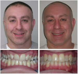 Mansur Before After at Orthodontic Specialist PC in in Brooklyn Staten Island NY and Metuchen NJ