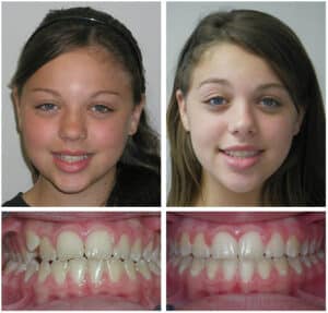 Patient Before and After Photos at Orthodontic Specialist PC in Brooklyn Staten Island NY and Metuchen NJ