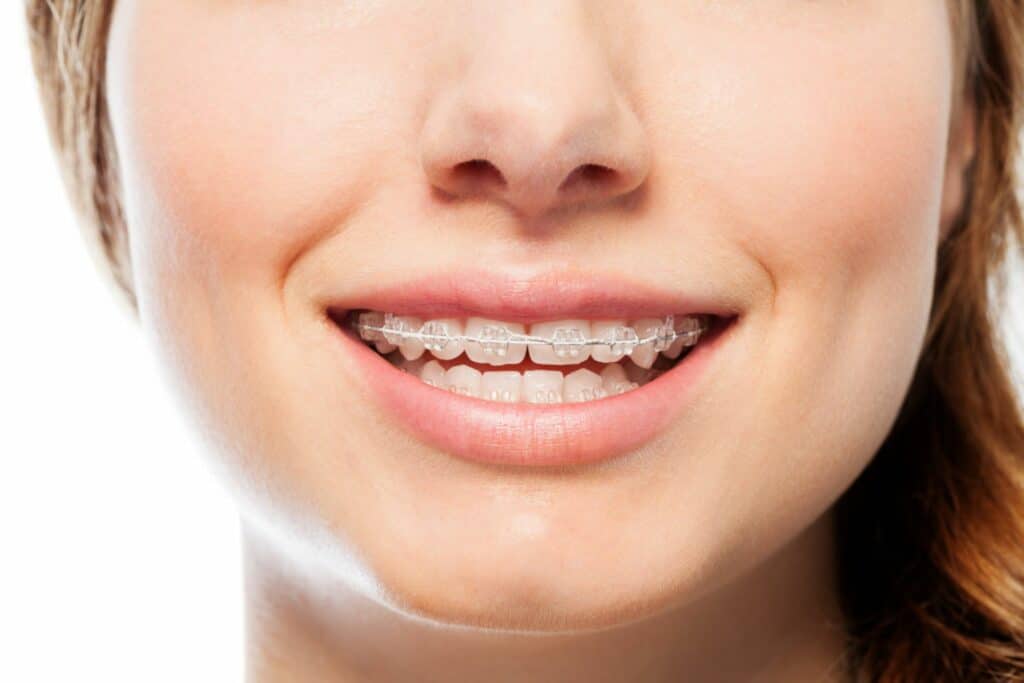 Do Braces Hurt? What to Expect During Treatment Orthodontic Specialist P.C in Metuchen, NJ
