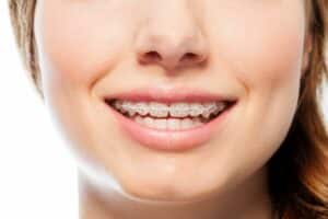 Do Braces Hurt? What to Expect During Treatment Orthodontic Specialist P.C in Metuchen, NJ